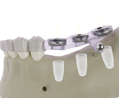 Digital image showing surgical guide for dental implants